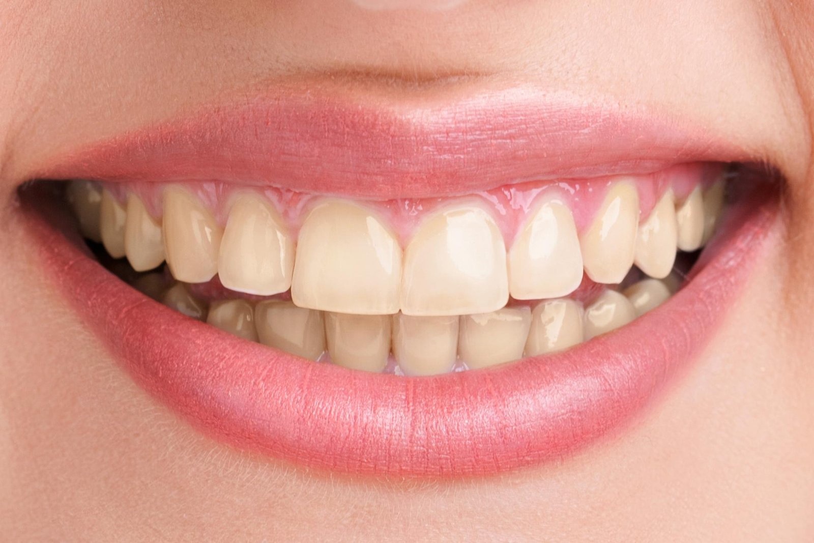 Teeth Before Treatment Showing Enamel Staining